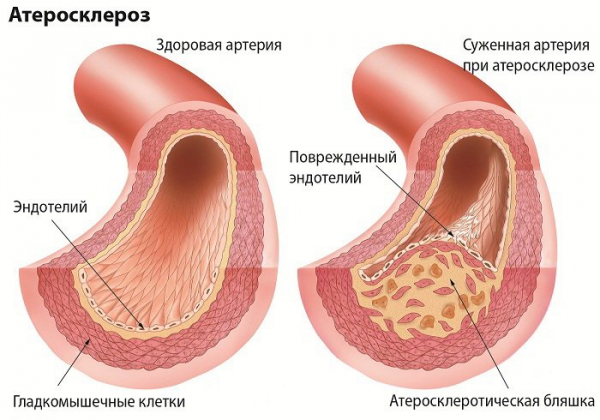 Атеросклероз — симптомы, причины и лечение атеросклероза
